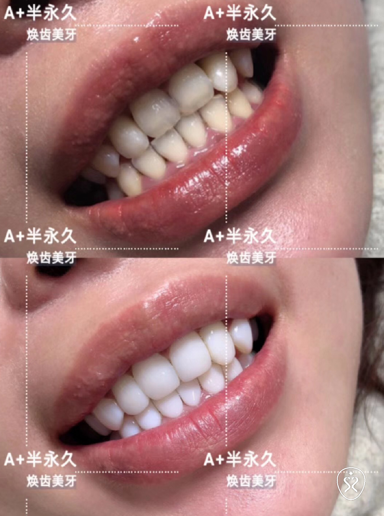 樹脂貼片完成照
